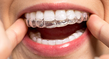 Closeup of patient placing clear braces tray