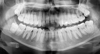 Full mouth panoramic smile x-ray