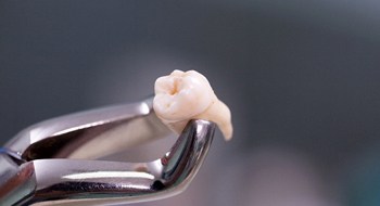 An extracted tooth